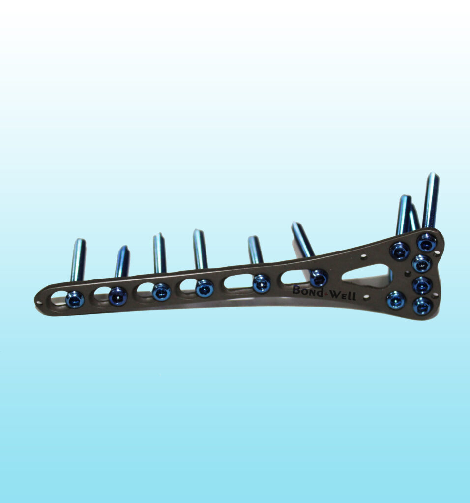 Volar Column Distal Radius Locking Plate - Bond Well Ortho